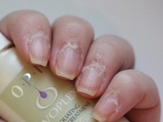 Ремувер для кутикули: як користуватися і чим можна замінити? Як за допомогою ремувера видалити кутикулу? Відгуки