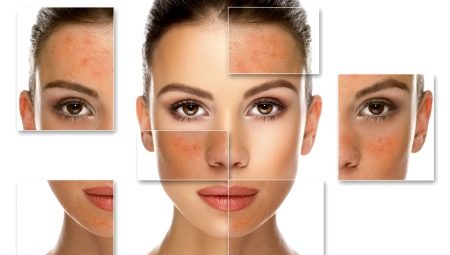 Саліциловий пілінг (29 фото): рецепт з кислотою для хімічної процедури від прищів, як робити в домашніх умовах, відгуки