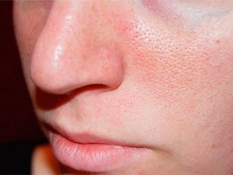 Саліциловий пілінг (29 фото): рецепт з кислотою для хімічної процедури від прищів, як робити в домашніх умовах, відгуки