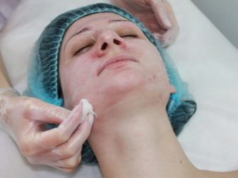 Саліциловий пілінг (29 фото): рецепт з кислотою для хімічної процедури від прищів, як робити в домашніх умовах, відгуки