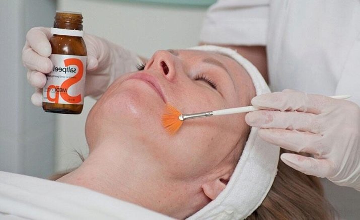 Саліциловий пілінг (29 фото): рецепт з кислотою для хімічної процедури від прищів, як робити в домашніх умовах, відгуки