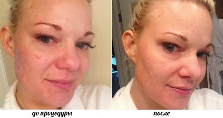 Саліциловий пілінг (29 фото): рецепт з кислотою для хімічної процедури від прищів, як робити в домашніх умовах, відгуки