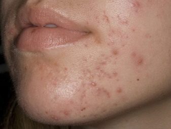 Саліциловий пілінг (29 фото): рецепт з кислотою для хімічної процедури від прищів, як робити в домашніх умовах, відгуки