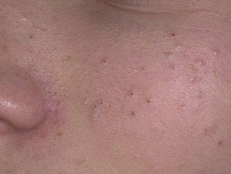 Саліциловий пілінг (29 фото): рецепт з кислотою для хімічної процедури від прищів, як робити в домашніх умовах, відгуки