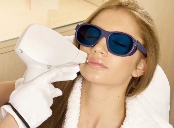 Що робити, якщо в дівчини ростуть вуса? Як назавжди прибрати їх в домашніх умовах? Як швидко видалити або знебарвити вуса у жінок?