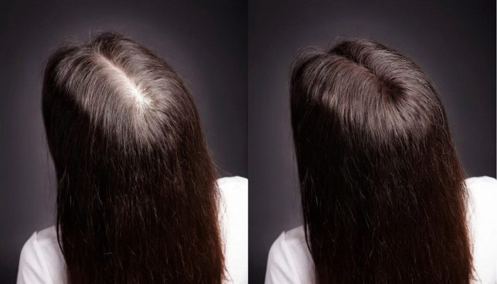 Сироватка для росту волосся Alerana: діє як засіб проти випадіння волосся? Інструкція по застосуванню та відгуки трихолог