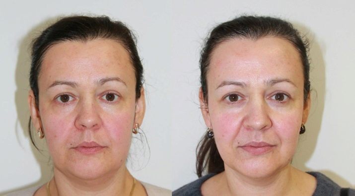 Як підтягнути овал обличчя? 48 фото Вправи для підтяжки в домашніх умовах, як прибрати носогубні складки