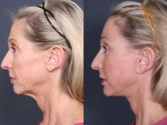 Як підтягнути овал обличчя? 48 фото Вправи для підтяжки в домашніх умовах, як прибрати носогубні складки