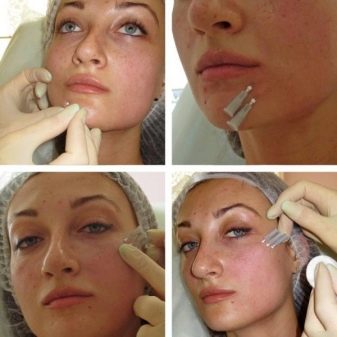 Як підтягнути овал обличчя? 48 фото Вправи для підтяжки в домашніх умовах, як прибрати носогубні складки