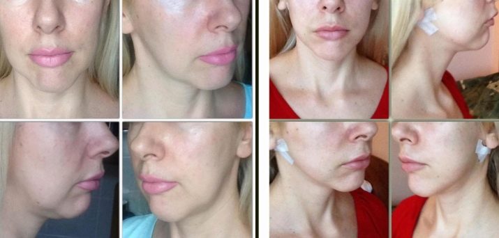 Як підтягнути овал обличчя? 48 фото Вправи для підтяжки в домашніх умовах, як прибрати носогубні складки